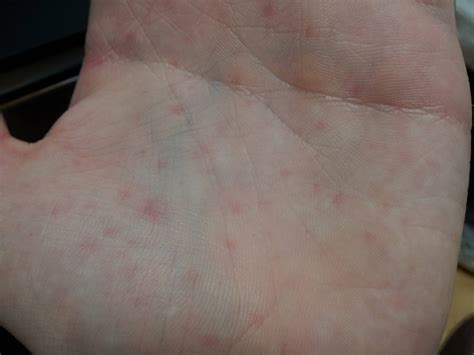 red blotches on hands